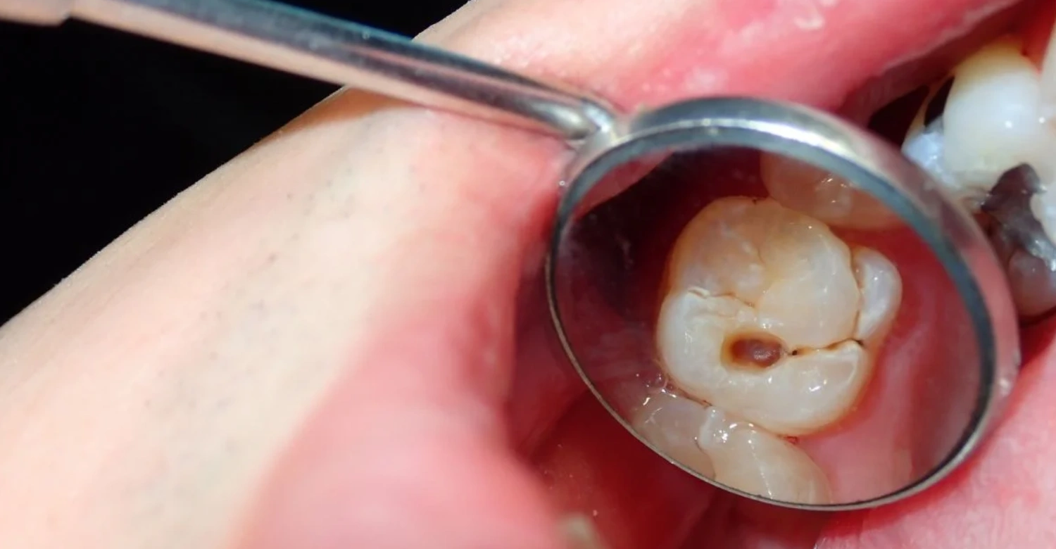 Tooth Decay Pain Causes, Symptoms, and Relief Inblog